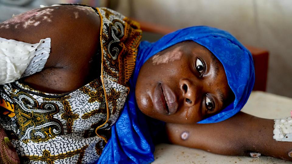 تقع Sifa Mohammed على سرير في المستشفى في حشد رأس أزرق ولباس منقوش مع ضمادات على ذراعيها وعلامات الحرق على جلدها