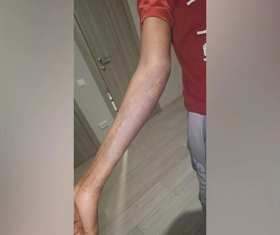 رجل يمد ذراعه. هناك مساحة كبيرة من تغير اللون.