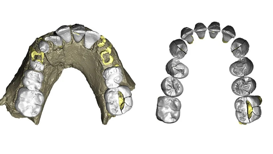 عرض ثلاثي الأبعاد لعظم الفك، الذي ينتمي إلى حدث A. deyiremeda الذي كان عمره حوالي أربع سنوات. - آنا راجني