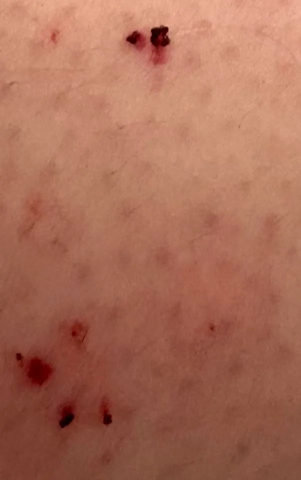 نقل الزواحف سيدني فيسبوك لدغات الثعبان المشتبه بها