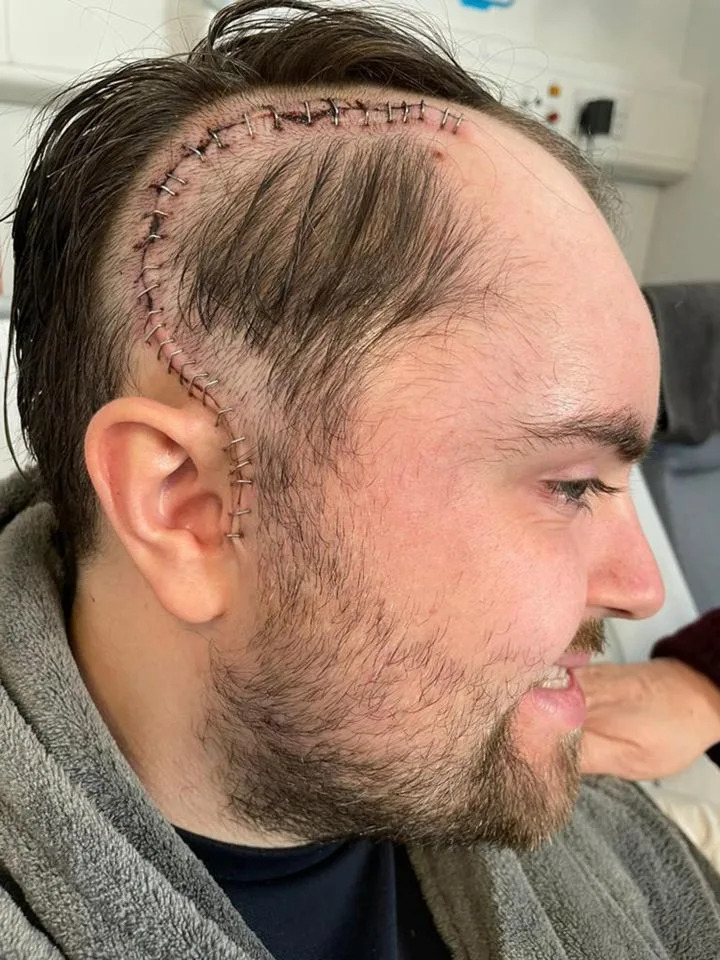 أبحاث أورام الدماغ شون سويني